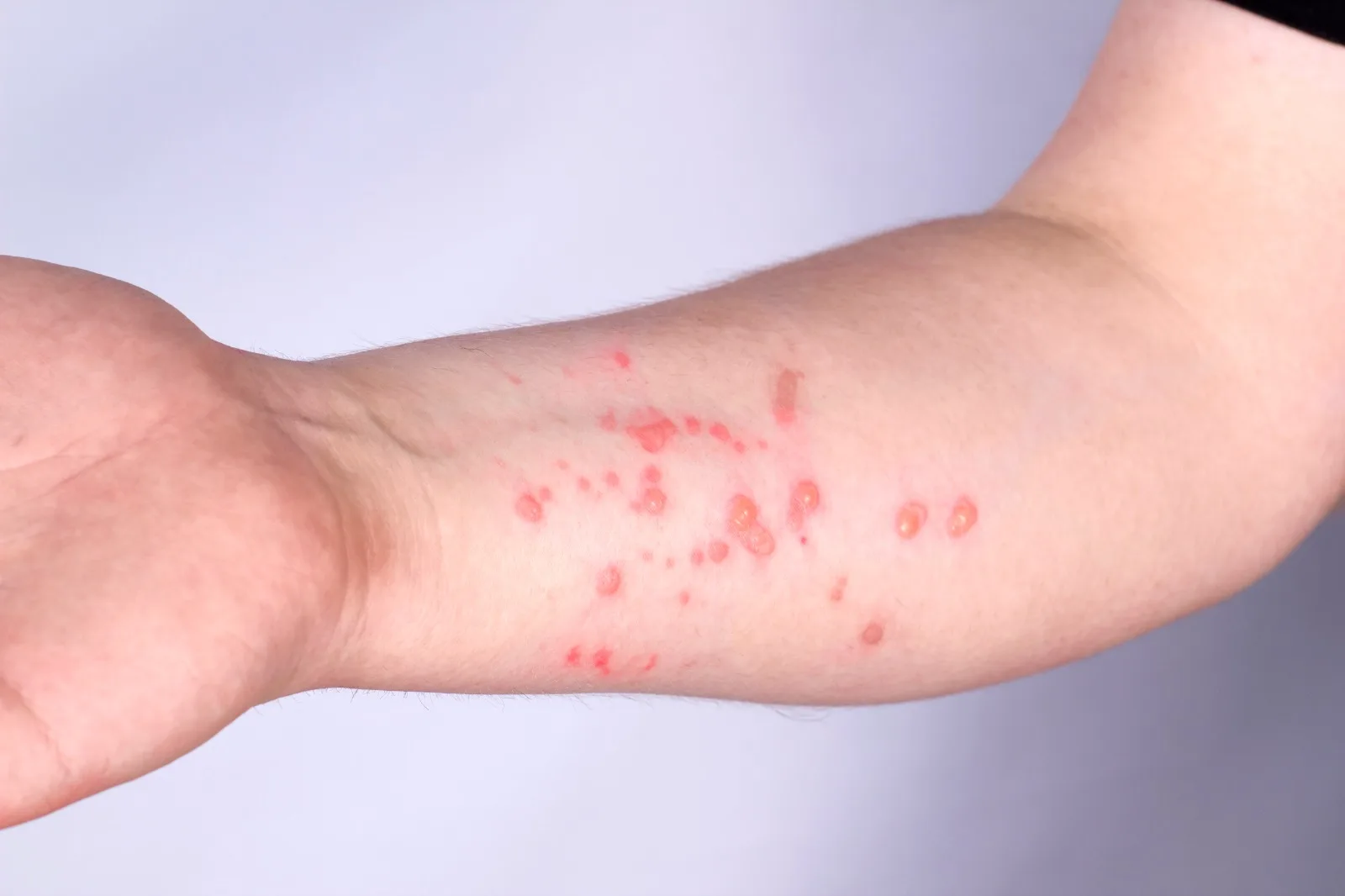 Jundiaí confirma primeiro caso de mpox em 2026 e alerta população